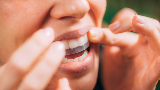 close-up shot of a woman's mouth using whitening strips