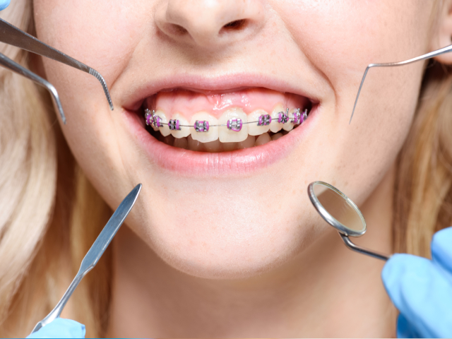 Braces