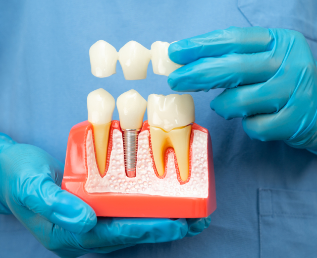 Dental Bridges
