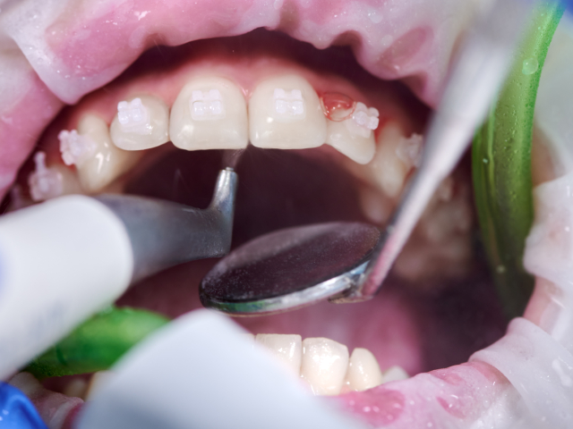 Dental Cleanings