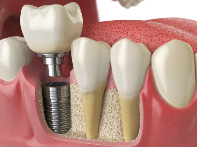 Dental Implants