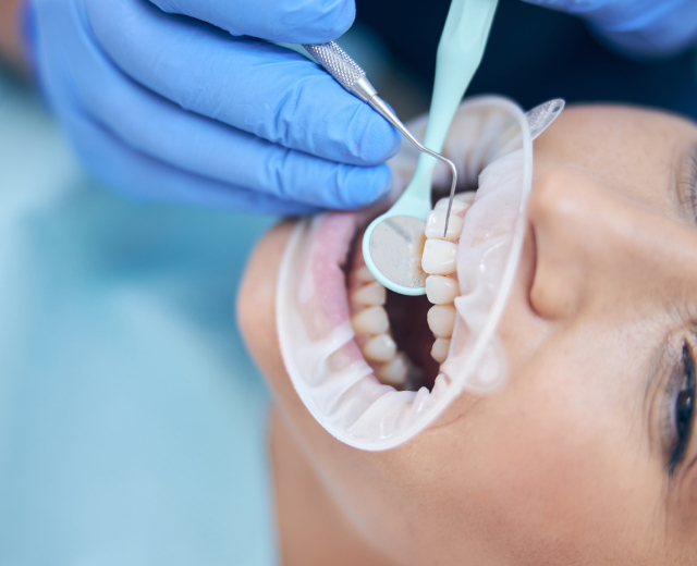 Dental Sealants
