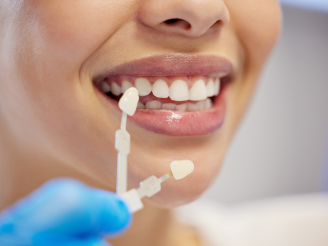 Porcelain Veneers