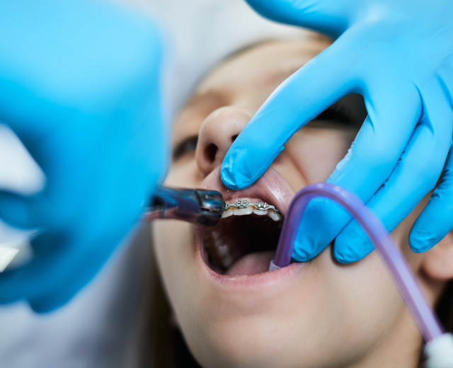 Types of Tooth Extractions We Perform