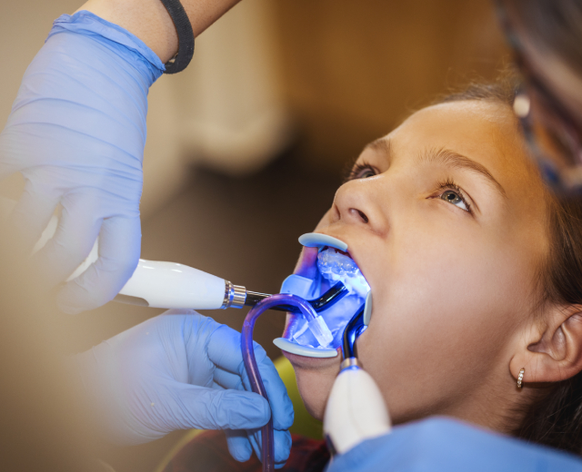 What Are Dental Sealants