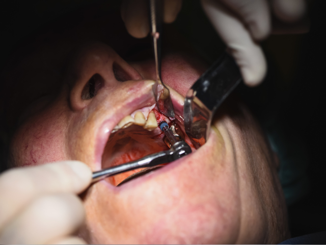 What Is Bone Grafting