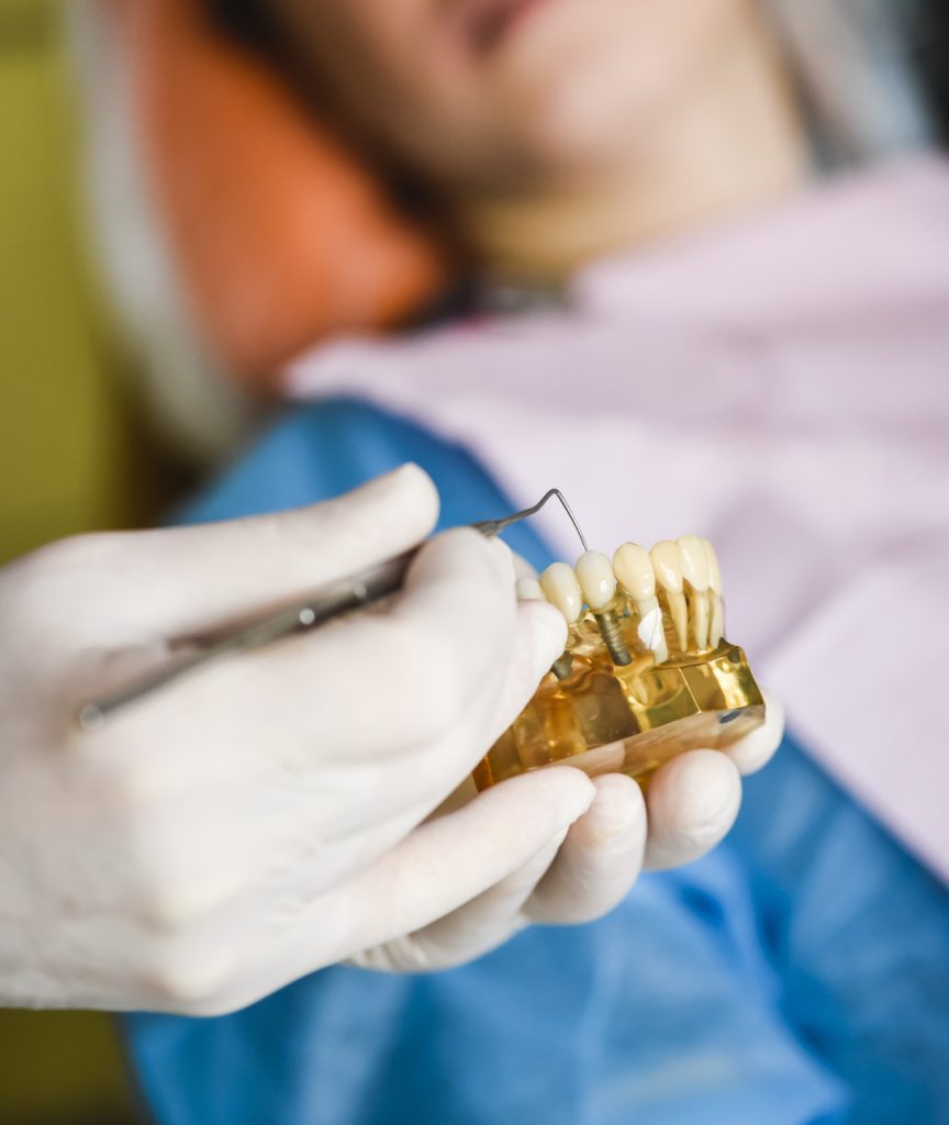Why Choose Dental Implants