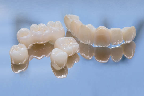 ceramic dental crowns