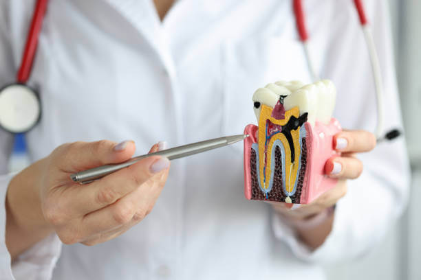 Dentist holding a tooth model, demonstrating interdental cavities during a dental consultation.