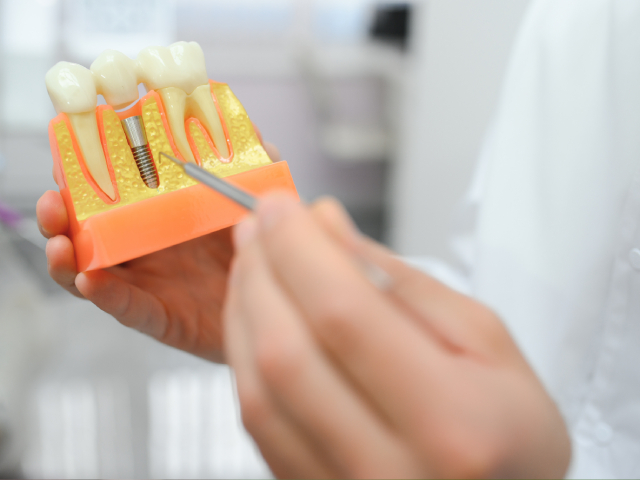 Bone Grafting for Implants