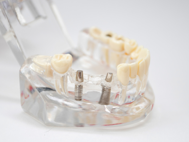 Implant-Supported Bridges