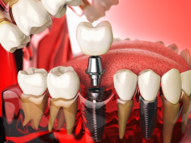Single Tooth Implants