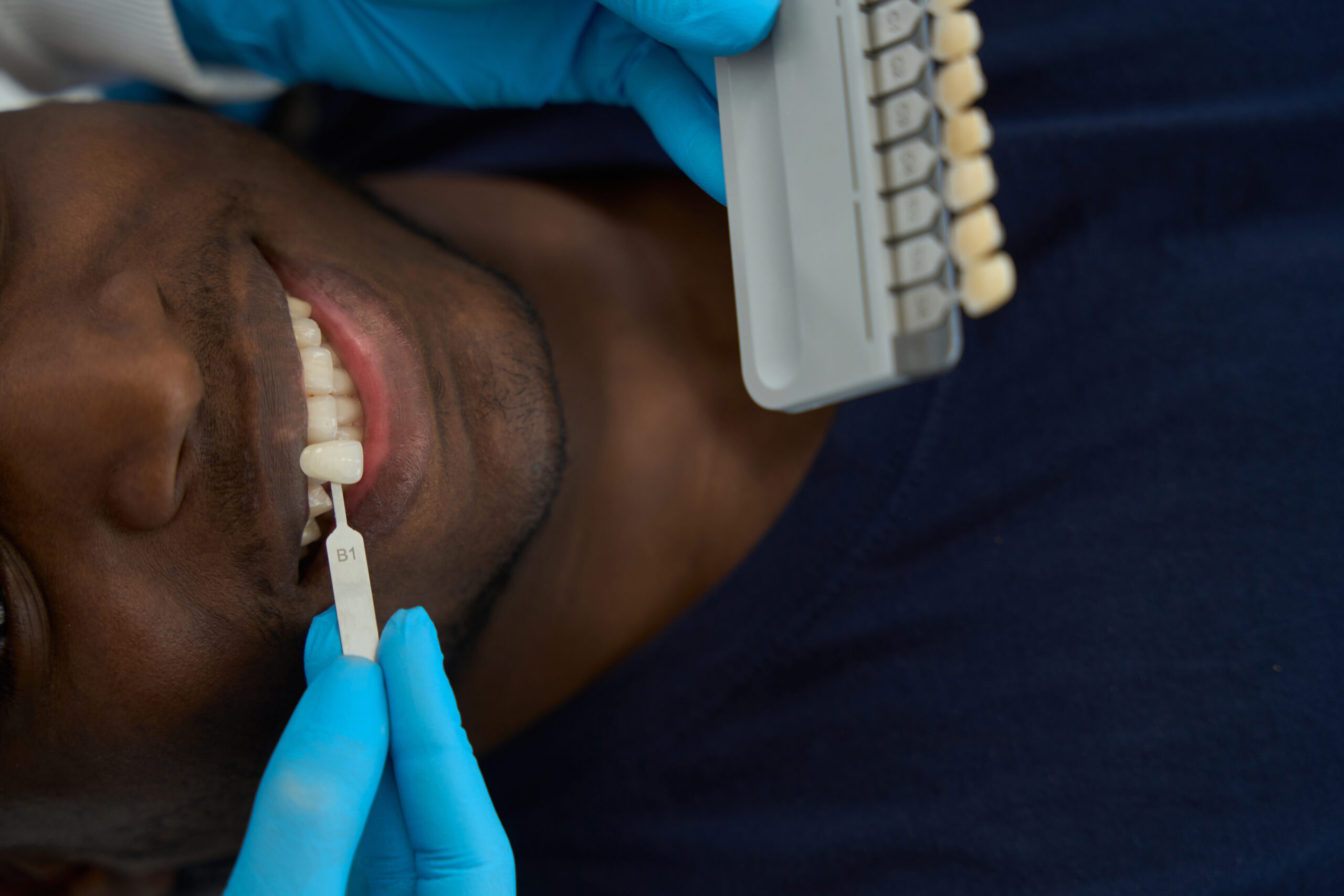 dental-bridge-placement